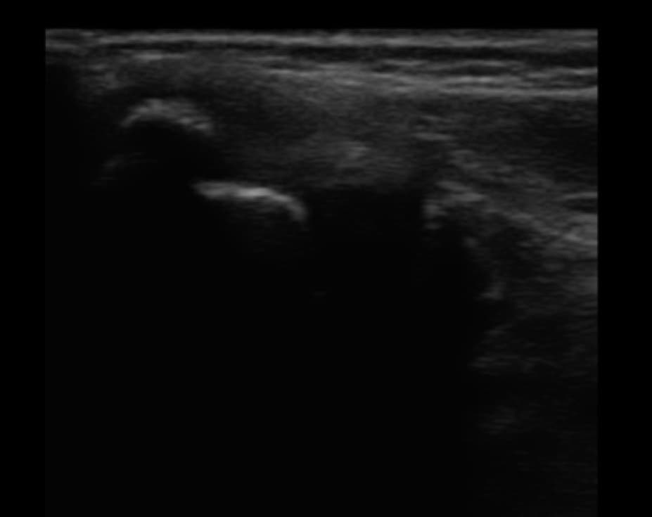 野球肘のエコー写真