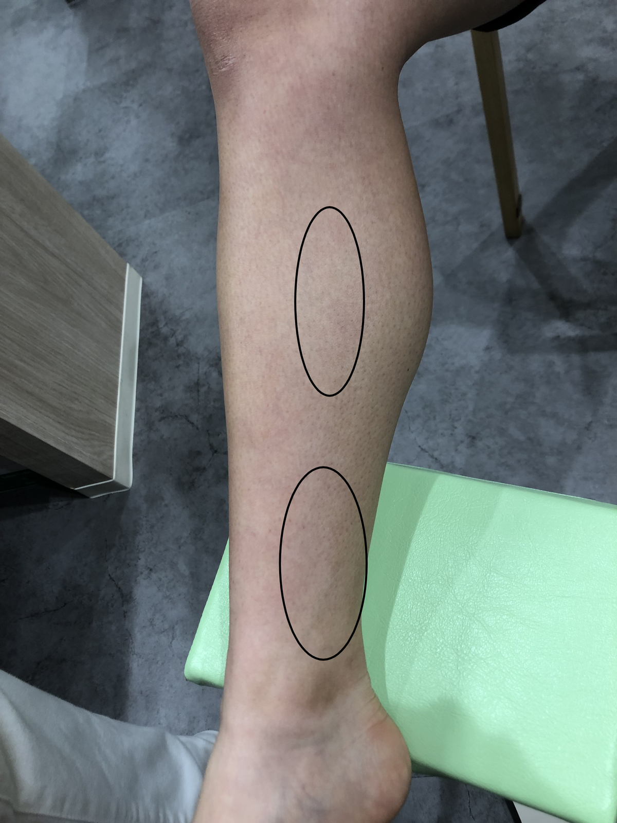 シンスプリントの画像