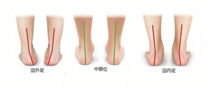 回外足・中間位・回内足の画像