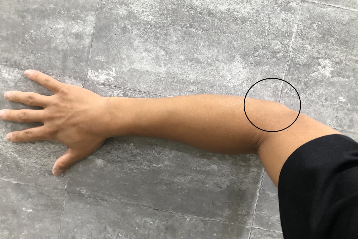 坐骨神経痛画像