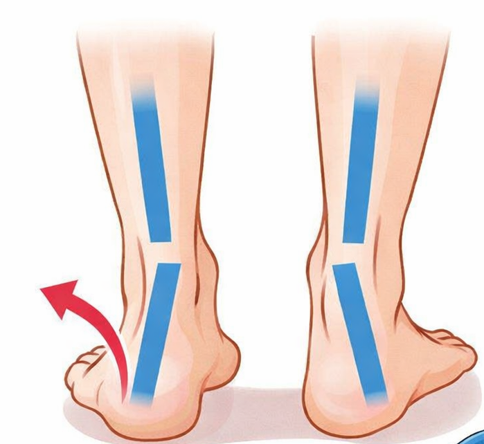 オーバープロネーション